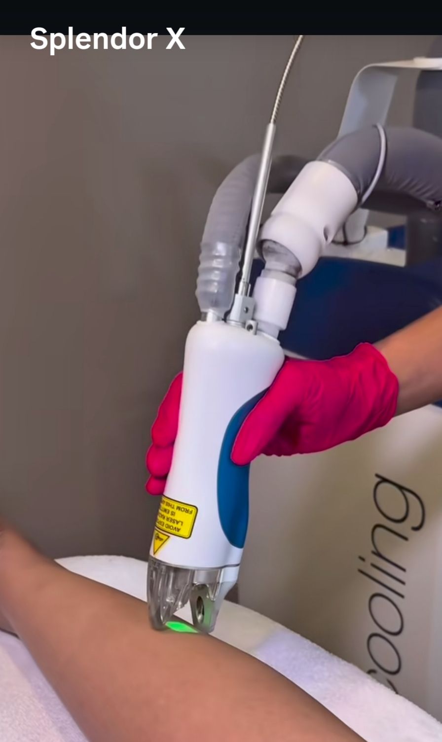 Fibra compatible con depilación láser Splendor X – Lumenis 755 nm/1064 nm (punto cuadrado)